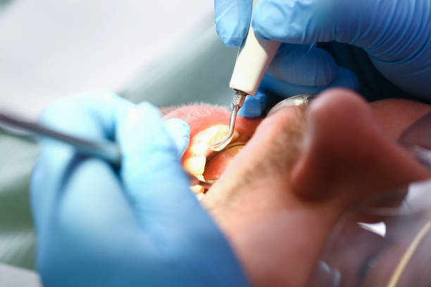 Best Emergency Dental Extractions in Beltsville, MD