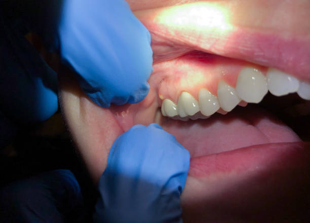 Best Broken or Cracked Tooth Emergency Dentist in Beltsville, MD
